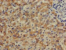 CTH / Cystathionase Antibody - Immunohistochemistry of paraffin-embedded human liver cancer using CTH Antibody at dilution of 1:100