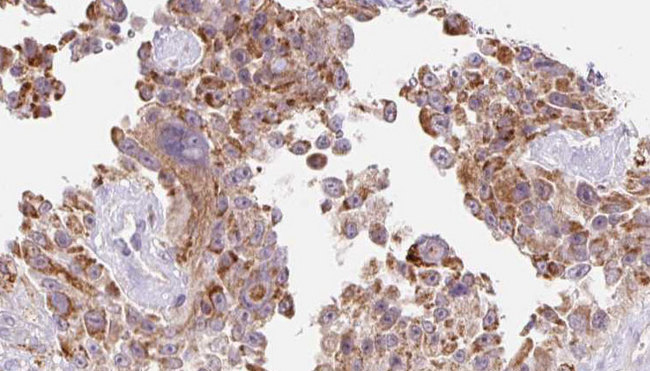 CTHRC1 Antibody - 1:100 staining human Melanoma tissue by IHC-P. The sample was formaldehyde fixed and a heat mediated antigen retrieval step in citrate buffer was performed. The sample was then blocked and incubated with the antibody for 1.5 hours at 22°C. An HRP conjugated goat anti-rabbit antibody was used as the secondary.