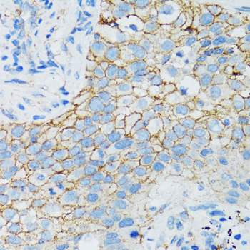 CTNNA1 / Catenin Alpha-1 Antibody - Immunohistochemistry of paraffin-embedded human lung cancer tissue.