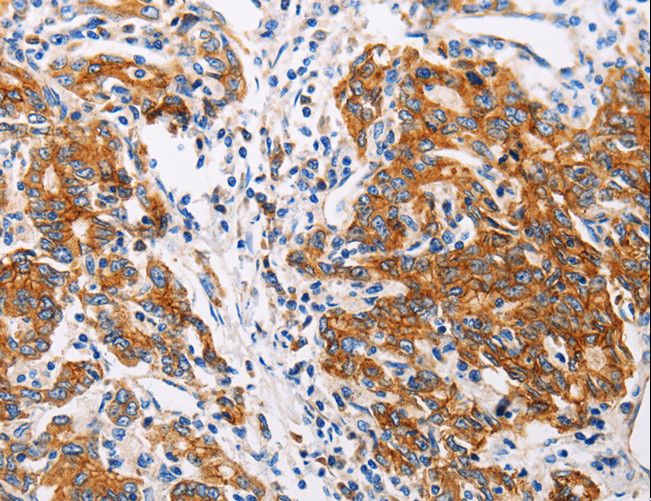 CTNNA1 / Catenin Alpha-1 Antibody - Immunohistochemistry of paraffin-embedded Human gastric cancer using CTNNA1 Polyclonal Antibody at dilution of 1:35.
