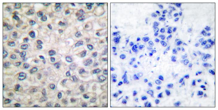 CTNNA1 / Catenin Alpha-1 Antibody - Peptide - + Immunohistochemical analysis of paraffin-embedded human breast carcinoma tissue using Catenin-a antibody.
