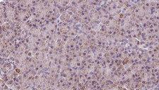 CTNNA3 / Alpha-3 Catenin Antibody - 1:100 staining human pancreas carcinoma tissue by IHC-P. The sample was formaldehyde fixed and a heat mediated antigen retrieval step in citrate buffer was performed. The sample was then blocked and incubated with the antibody for 1.5 hours at 22°C. An HRP conjugated goat anti-rabbit antibody was used as the secondary.