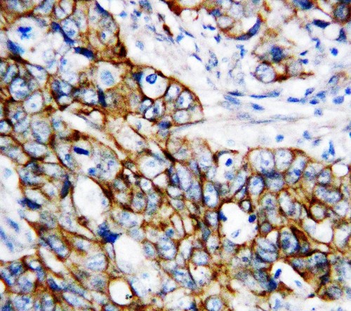 CTNNB1 / Beta Catenin Antibody - beta Catenin antibody IHC-paraffin: Human Mammary Cancer Tissue.