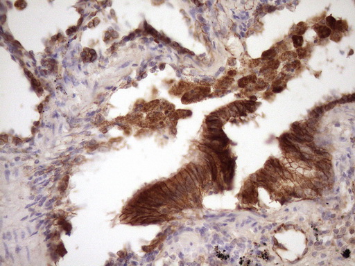 CTNNB1 / Beta Catenin Antibody - Immunohistochemical staining of paraffin-embedded Carcinoma of Human lung tissue using anti-CTNNB1 mouse monoclonal antibody. (Heat-induced epitope retrieval by Tris-EDTA, pH8.0)(1:150)