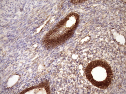 CTNNB1 / Beta Catenin Antibody - Immunohistochemical staining of paraffin-embedded Carcinoma of Human pancreas tissue using anti-CTNNB1 mouse monoclonal antibody. (Heat-induced epitope retrieval by Tris-EDTA, pH8.0)(1:150)