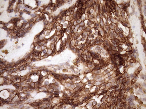 CTNNB1 / Beta Catenin Antibody - Immunohistochemical staining of paraffin-embedded Adenocarcinoma of Human breast tissue using anti-CTNNB1 mouse monoclonal antibody. (Heat-induced epitope retrieval by Tris-EDTA, pH8.0)(1:150)