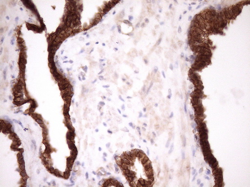 CTNNB1 / Beta Catenin Antibody - Immunohistochemical staining of paraffin-embedded Carcinoma of Human prostate tissue using anti-CTNNB1 mouse monoclonal antibody. (Heat-induced epitope retrieval by Tris-EDTA, pH8.0)(1:150)