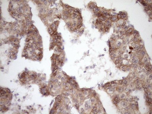 CTNNB1 / Beta Catenin Antibody - Immunohistochemical staining of paraffin-embedded Carcinoma of Human liver tissue using anti-CTNNB1 mouse monoclonal antibody. (Heat-induced epitope retrieval by Tris-EDTA, pH8.0)(1:150)