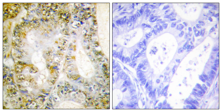 CTNNB1 / Beta Catenin Antibody - Immunohistochemistry analysis of paraffin-embedded human breast carcinoma tissue, using Catenin-beta1 Antibody. The picture on the right is blocked with the synthesized peptide.