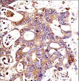CTNNB1 / Beta Catenin Antibody - CTNNB1 Antibody immunohistochemistry of formalin-fixed and paraffin-embedded human colon carcinoma followed by peroxidase-conjugated secondary antibody and DAB staining.