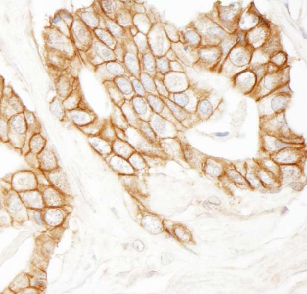 CTNNB1 / Beta Catenin Antibody - Detection of Human Beta-catenin by Immunohistochemistry. Sample: FFPE section of human prostate carcinoma. Antibody: Affinity purified rabbit anti-Beta-catenin used at a dilution of 1:200 (1 ug/ml).