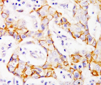 CTNNB1 / Beta Catenin Antibody - IHC-P: beta Catenin antibody testing of human breast cancer tissue