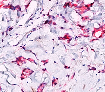 CTNNB1 / Beta Catenin Antibody - Formalin/paraffin breast lobular carcinoma stained with beta-Catenin p120 antibody. Note cytoplasmic staining in lobular carcinoma.  This image was taken for the unmodified form of this product. Other forms have not been tested.
