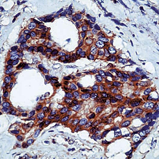 CTNNB1 / Beta Catenin Antibody - Formalin-fixed, paraffin-embedded human breast carcinoma stained with beta-Catenin antibody.