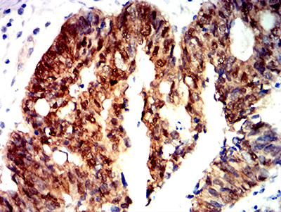 CTNNB1 / Beta Catenin Antibody - Immunohistochemical analysis of paraffin-embedded rectum cancer tissues using CTNNB1 mouse mAb with DAB staining.