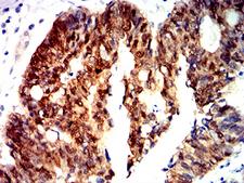 CTNNB1 / Beta Catenin Antibody - Immunohistochemical analysis of paraffin-embedded rectum cancer tissues using CTNNB1 mouse mAb with DAB staining.