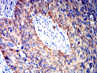 CTNNB1 / Beta Catenin Antibody - Immunohistochemical analysis of paraffin-embedded cervical cancer tissues using CTNNB1 mouse mAb with DAB staining.
