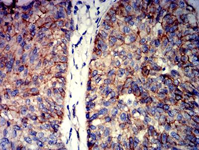 CTNNB1 / Beta Catenin Antibody - Immunohistochemical analysis of paraffin-embedded bladder cancer tissues using CTNNB1 mouse mAb with DAB staining.