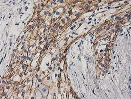 CTNNB1 / Beta Catenin Antibody - IHC of paraffin-embedded Carcinoma of Human pancreas tissue using anti-CTNNB1 mouse monoclonal antibody.