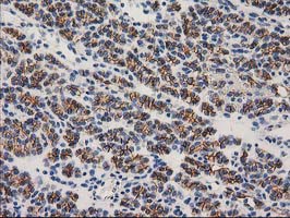 CTNNB1 / Beta Catenin Antibody - IHC of paraffin-embedded Carcinoma of Human thyroid tissue using anti-CTNNB1 mouse monoclonal antibody.