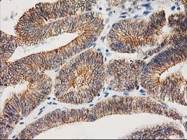 CTNNB1 / Beta Catenin Antibody - IHC of paraffin-embedded Adenocarcinoma of Human endometrium tissue using anti-CTNNB1 mouse monoclonal antibody.