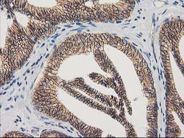 CTNNB1 / Beta Catenin Antibody - IHC of paraffin-embedded Carcinoma of Human prostate tissue using anti-CTNNB1 mouse monoclonal antibody.