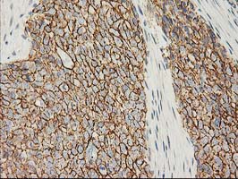 CTNNB1 / Beta Catenin Antibody - IHC of paraffin-embedded Adenocarcinoma of Human breast tissue using anti-CTNNB1 mouse monoclonal antibody. (Heat-induced epitope retrieval by 10mM citric buffer, pH6.0, 100C for 10min).