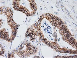 CTNNB1 / Beta Catenin Antibody - IHC of paraffin-embedded Adenocarcinoma of Human colon tissue using anti-CTNNB1 mouse monoclonal antibody. (Heat-induced epitope retrieval by 10mM citric buffer, pH6.0, 100C for 10min).