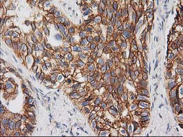 CTNNB1 / Beta Catenin Antibody - IHC of paraffin-embedded Carcinoma of Human lung tissue using anti-CTNNB1 mouse monoclonal antibody. (Heat-induced epitope retrieval by 10mM citric buffer, pH6.0, 100C for 10min).