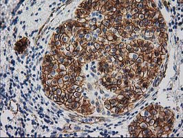 CTNNB1 / Beta Catenin Antibody - IHC of paraffin-embedded Carcinoma of Human pancreas tissue using anti-CTNNB1 mouse monoclonal antibody. (Heat-induced epitope retrieval by 10mM citric buffer, pH6.0, 100C for 10min).