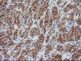 CTNNB1 / Beta Catenin Antibody - IHC of paraffin-embedded Carcinoma of Human thyroid tissue using anti-CTNNB1 mouse monoclonal antibody. (Heat-induced epitope retrieval by 10mM citric buffer, pH6.0, 100C for 10min).