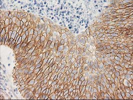 CTNNB1 / Beta Catenin Antibody - IHC of paraffin-embedded Carcinoma of Human bladder tissue using anti-CTNNB1 mouse monoclonal antibody. (Heat-induced epitope retrieval by 10mM citric buffer, pH6.0, 100C for 10min).