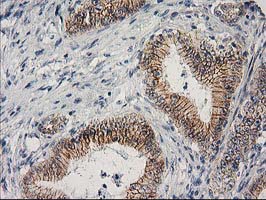 CTNNB1 / Beta Catenin Antibody - IHC of paraffin-embedded Adenocarcinoma of Human colon tissue using anti-CTNNB1 mouse monoclonal antibody. At a dilution of 1:150.
