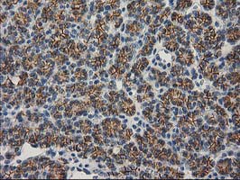 CTNNB1 / Beta Catenin Antibody - IHC of paraffin-embedded Carcinoma of Human thyroid tissue using anti-CTNNB1 mouse monoclonal antibody. At a dilution of 1:150.