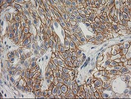 CTNNB1 / Beta Catenin Antibody - IHC of paraffin-embedded Carcinoma of Human bladder tissue using anti-CTNNB1 mouse monoclonal antibody.