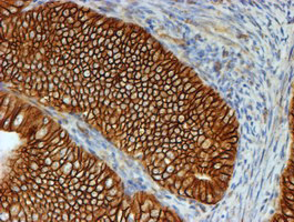 CTNNB1 / Beta Catenin Antibody - IHC of paraffin-embedded Adenocarcinoma of Human endometrium tissue using anti-CTNNB1 mouse monoclonal antibody. (Heat-induced epitope retrieval by 10mM citric buffer, pH6.0, 100C for 10min).