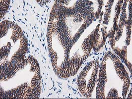 CTNNB1 / Beta Catenin Antibody - IHC of paraffin-embedded Carcinoma of Human prostate tissue using anti-CTNNB1 mouse monoclonal antibody.