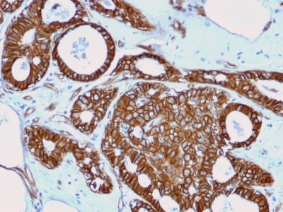 CTNNB1 / Beta Catenin Antibody - Formalin-fixed, paraffin-embedded human Breast Cancer stained with Beta-Catenin Mouse Recombinant Monoclonal Ab (rCTNNB1/2173).