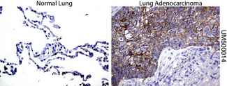 CTNNB1 / Beta Catenin Antibody - Immunohistochemical staining of paraffin-embedded human normal lung and lung Adenocarcinoma tissues using anti-beta-catenin mouse monoclonal antibody. (Clone UMAB14, dilution 1:100; heat-induced epitope retrieval by 10mM citric buffer, pH6.0, 120C for 3mi