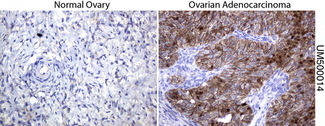 CTNNB1 / Beta Catenin Antibody - Immunohistochemical staining of paraffin-embedded human normal ovary and Adenocarcinoma of the ovary tissues using anti-beta-catenin mouse monoclonal antibody. (Clone UMAB14, dilution 1:100; heat-induced epitope retrieval by 10mM citric buffer, pH6.0, 120