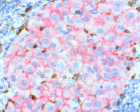 CTNNB1 / Beta Catenin Antibody - Sequential double staining of paraffin human melanoma using bCatenin(red) and PD1(brown). Both abs at 1:800 dilution of 1mg/mL. Anti-PD1: heat-induced epitope retrieval with Accel; anti-bCatenin: citrate pH6.0. The image of shows the tumor cells are strongly positve for beta-catenin. (red) are negative for PD-1. The activated TCells. (brown) show strong membranous and cytoplasmic staining for PD-1 and no staining with Beta Catenin.