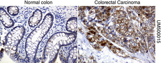 CTNNB1 / Beta Catenin Antibody - Immunohistochemical staining of paraffin-embedded Human normal colon and colorectal carcinoma tissues using anti-beta-catenin mouse monoclonal antibody. Note: beta-catenin is mostly located at membrane/cytoplasmic region, but exhibited intensive nuclear s