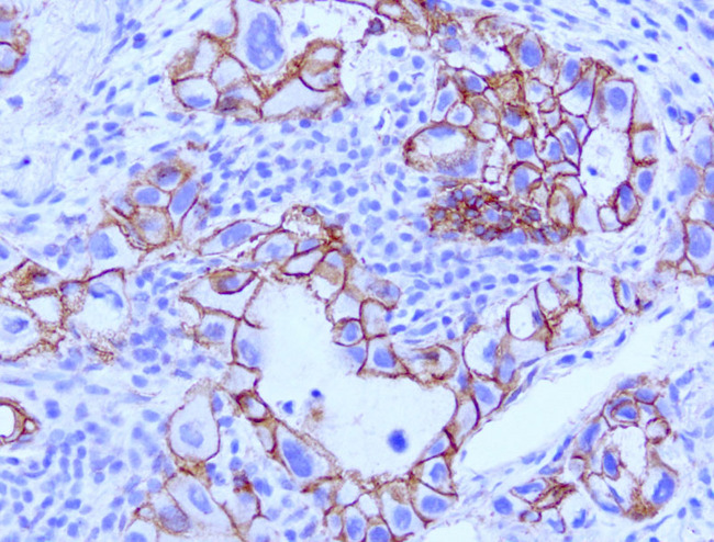 CTNNB1 / Beta Catenin Antibody - Immunohistochemical staining of paraffin-embedded human lung cancer with mouse anti-Beta Catenin clone UMAB15 1:200 using HIER citrate pressure chamber. Tumor cells show positive membrane staining.