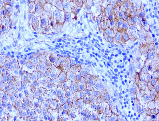 CTNNB1 / Beta Catenin Antibody - Immunohistochemical staining of paraffin-embedded human melanoma metastisis to lymph node with mouse anti-Beta Catenin clone UMAB15 1:200 using HIER citrate pressure chamber. Tumor cells show positive membrane and cytoplasmic staining.