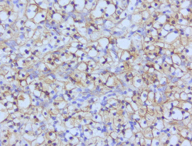 CTNNB1 / Beta Catenin Antibody - Immunohistochemical staining of paraffin-embedded human renal cell carcinoma with mouse anti-Beta Catenin clone UMAB15 1:200 using HIER citrate pressure chamber. Tumor cells show positive membrane staining.