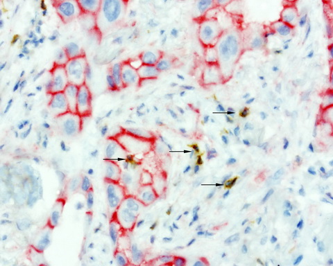 CTNNB1 / Beta Catenin Antibody - Sequential double staining of paraffin human melanoma using bCatenin(red) and PD1(brown). Both abs at 1:800 dilution of 1mg/mL. Anti-PD1: heat-induced epitope retrieval with Accel; anti-bCatenin: citrate pH6.0. Image shows the tumor cells are strongly positve for b-catenin. (red) and negative for PD1. The arrows point to the activated T cells. (brown) show strong membranous and cytoplasmic staining of PD1 and no staining with bCatenin.