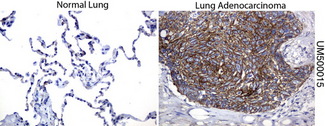 CTNNB1 / Beta Catenin Antibody - Immunohistochemical staining of paraffin-embedded human normal lung and lung Adenocarcinoma tissues using anti-beta-catenin mouse monoclonal antibody. (Clone UMAB15, dilution 1:100; heat-induced epitope retrieval by 10mM citric buffer, pH6.0, 120C for 3mi