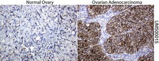 CTNNB1 / Beta Catenin Antibody - Immunohistochemical staining of paraffin-embedded human normal ovary and Adenocarcinoma of the ovary tissues using anti-beta-catenin mouse monoclonal antibody. (Clone UMAB15, dilution 1:100; heat-induced epitope retrieval by 10mM citric buffer, pH6.0, 120