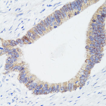 CTNNB1 / Beta Catenin Antibody - Immunohistochemistry of paraffin-embedded human colon carcinoma using CTNNB1 antibody at dilution of 1:150 (40x lens).