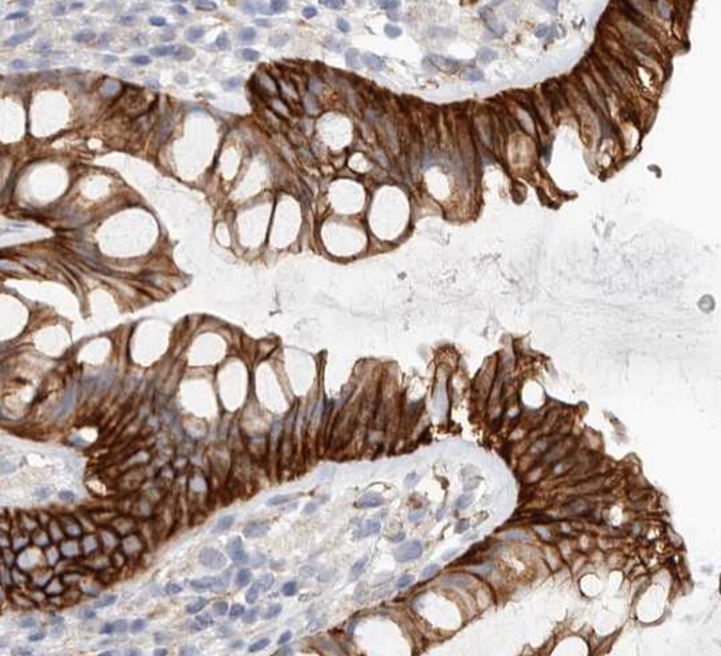 CTNNB1 / Beta Catenin Antibody - showing positive staining in colon carcinoma tissue.